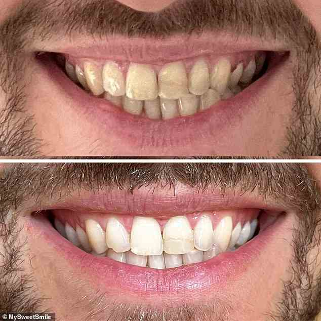 Das MySweetSmile Teeth Whitening Powder entfernt Verfärbungen und Vergilbungen, entfernt sanft oberflächliche Verfärbungen und verhindert gleichzeitig die Bildung von Zahnstein und Plaque