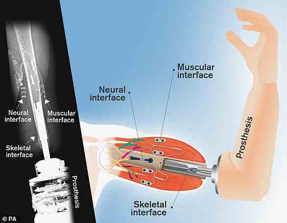 Drei Menschen in Schweden verwenden ein Implantatsystem, das es Amputierten ermöglicht, einen bionischen Arm nur mit ihren Gedanken zu verwenden.  Dr. Max Ortiz Cataln von der Chalmers University of Technology hofft, dass die Technologie auf Europa ausgeweitet werden kann.  Das Implantatsystem verankert die Prothese am Skelett im Stumpf der amputierten Extremität