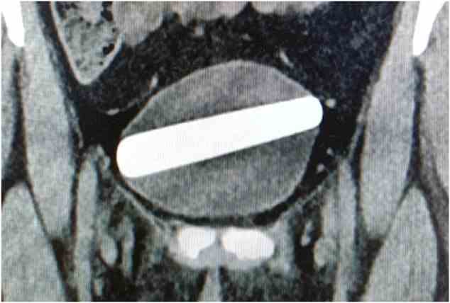 Die Patientin wurde einem Ultraschall und einer Röntgenaufnahme (im Bild) unterzogen, die zeigten, dass der 9 x 2,5 cm (3,5 x 1 Zoll) große Dildo horizontal in ihrer Blase stecken geblieben war
