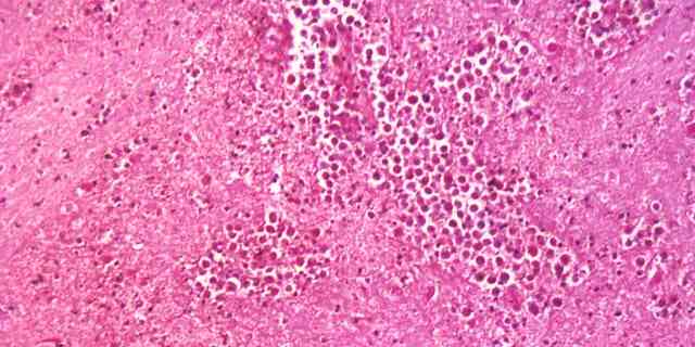 Unter 125-facher Vergrößerung zeigt diese Mikrofotografie einer Gehirngewebeprobe die zytoarchitektonischen Veränderungen, die mit einer freilebenden Amöbeninfektion von Naegleria fowleri verbunden sind.
