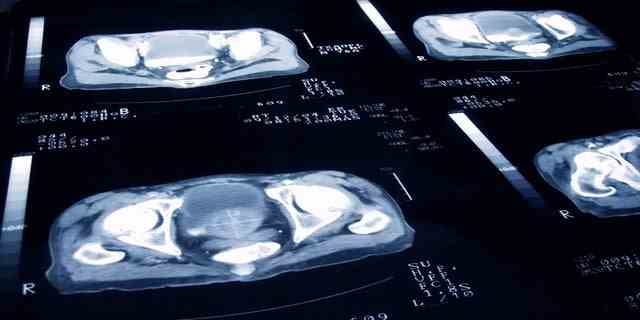 Röntgenbilder eines Patienten mit Prostatakrebs