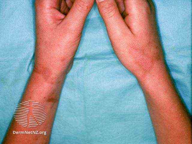 zwei Hände und Handgelenke mit brauner Hyperpigmentierung nach Phytophotodermatitus