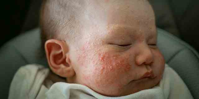 Babys mit Ekzemen, einem Zustand, der durch trockene, juckende Haut und Hautausschläge gekennzeichnet ist, haben ein höheres Risiko, Nahrungsmittelallergien zu entwickeln.