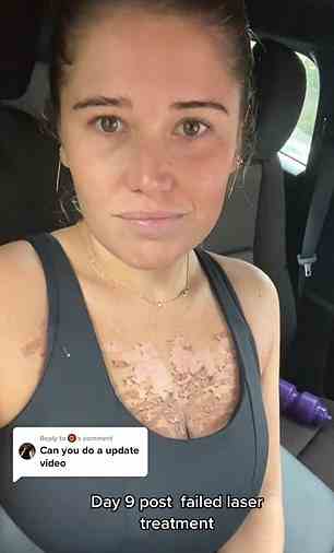 Die Frau aus Sydney, Clare Schimpl, hat zwei Videos geteilt, nachdem sie sich einer Laserpigmentierungsbehandlung auf TikTok unterzogen hatte, und sagte, sie sei als „Hautmodell“ an einen unbenannten Ort gegangen, wo sie eine neue Maschine getestet habe (siehe Bild).