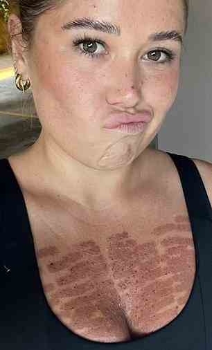 Die Frau aus Sydney, Clare Schimpl, hat zwei Videos geteilt, nachdem sie sich einer Laserpigmentierungsbehandlung auf TikTok unterzogen hatte, und sagte, sie sei als „Hautmodell“ an einen unbenannten Ort gegangen, wo sie eine neue Maschine getestet habe (siehe Bild).