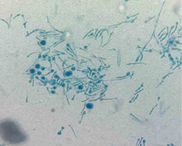 Erste Labortests zur Überprüfung auf Bakterien ergaben keinen Hinweis auf die Krankheit.  Aber ein weiterer Screening-Test ergab, dass ein Pilz (im Bild) vorhanden war