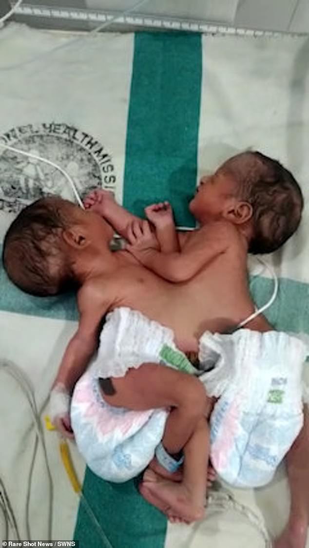 Die Babys – am Bauch verbunden, mit jeweils zwei Armen und zwei Beinen – wurden am Montag im Purnia Government Medical College Hospital in Bihar, Indien, geboren