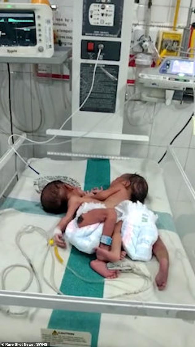 Im Bild: Die siamesischen Zwillinge im Krankenhaus.  Aufgrund der Seltenheit der Erkrankung wurde das Paar zur fachärztlichen Versorgung in ein größeres Krankenhaus verlegt.  Die Behandlung dauert an, aber das medizinische Team sagt, dass es den Kindern gut geht
