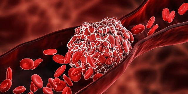 Blut besteht aus roten Blutkörperchen, weißen Blutkörperchen und Blutplättchen, die laut Cleveland Clinic im flüssigen Teil des Blutes schwimmen, der als Plasma bekannt ist.  Wenn wir bluten, löst dies die Koagulation – oder Gerinnungskaskade – aus, die Proteine ​​auf Blutplättchen aktiviert, um zu verklumpen, um das Loch im Blutgefäß zu füllen, damit wir die Blutung stoppen, erklärte ein Arzt. 