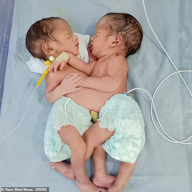 Shams Praveen, 22, und ihr Mann Zafar Alam wussten bis zu ihrer Geburt nicht, dass sie siamesische Zwillinge bekommen würden, deren Namen noch nicht bekannt sind