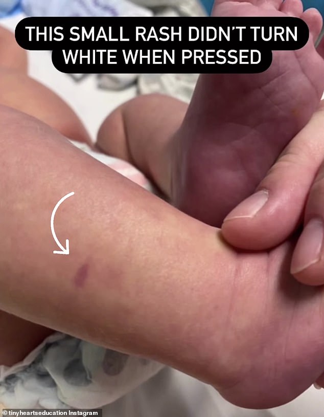Eine Mutter brachte ihr Baby ins Krankenhaus, nachdem sie einen winzigen Fleck am Bein entdeckt hatte (Bild).  Es stellte sich heraus, dass es ein Zeichen von Meningokokken war