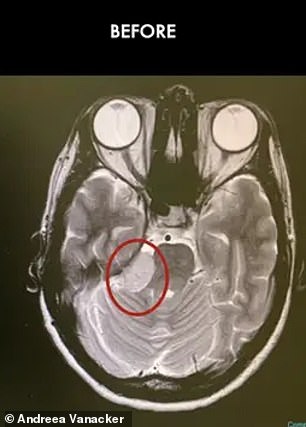 Oben abgebildet ist ihr Gehirn vor der Operation, wobei der Tumor innerhalb des roten Kreises dargestellt ist