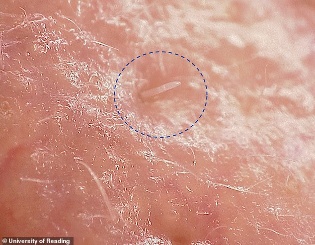 D. folliculorum-Milben werden von fast jedem Menschen im Gesicht, an den Wimpern und sogar an den Brustwarzen übertragen und bewegen sich zwischen den Follikeln auf der Suche nach einem Partner.  Bild zeigt Demodex folliculorum-Milbe auf der Haut unter dem Mikroskop