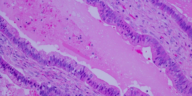 Bauchspeicheldrüsenkrebszellen