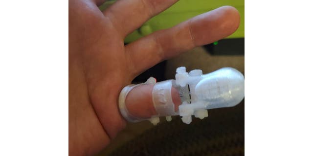 Männerhand mit durchsichtiger 3D-gedruckter Fingerprothese