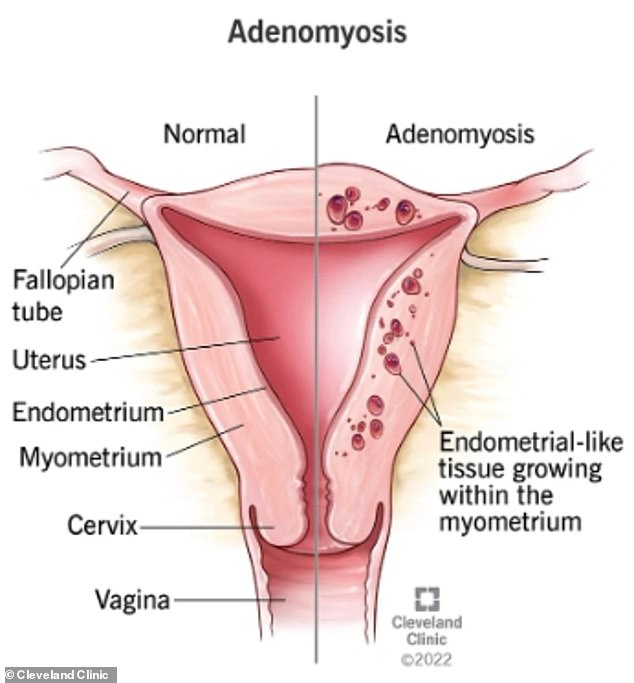 Es ist nicht genau bekannt, warum Adenomyose auftritt.  Der NHS stellt jedoch fest, dass es „wahrscheinlich“ ist, dass Frauen mit Adenomyose „aufgrund ihrer Gene, ihres Immunsystems und ihrer Hormone eine Veranlagung haben“.