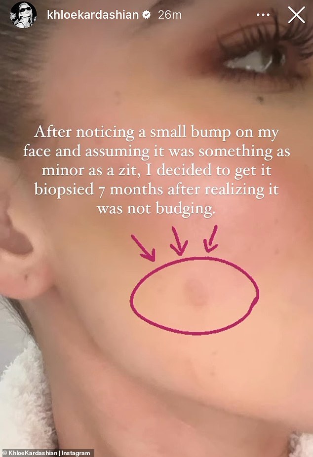 She tells the audience that she had a bump on her face biopsied after keeping an eye on it for 'seven or eight months'