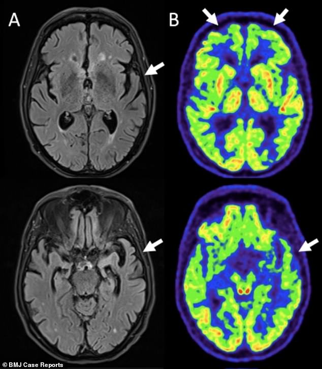 MRT-Scans des Gehirns des Patienten zeigten Anzeichen einer Alzheimer-Krankheit