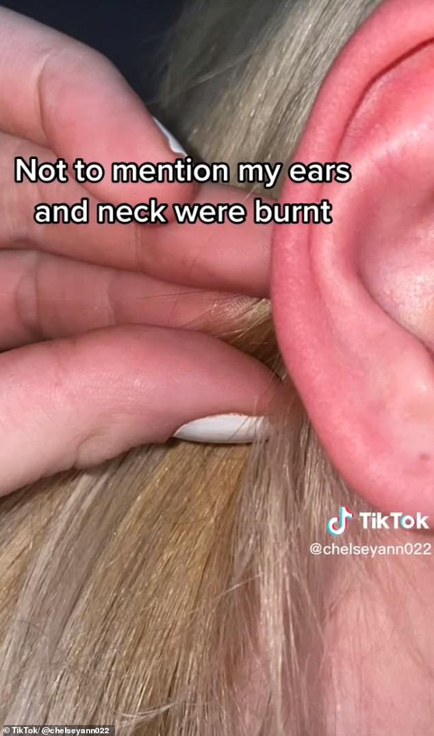 Chelsy Ann zeigte ihren Followern, dass ihre Ohren sowie ihr Hals und ihre Kopfhaut durch das Bleichmittel verbrannt waren