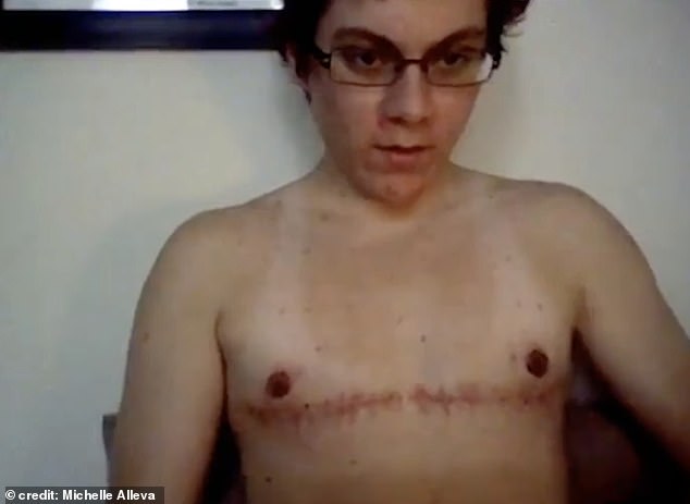 Michelle went back-and-forth with mental health issues - in which a number of diagnoses were made but her gender dysphoria left unexplored. She's pictured here after her mastectomy