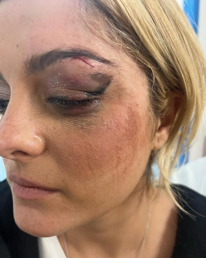 Bebe Rexha teilt Fotos mit blauen Augen, nachdem ihr ein Fan das Telefon ins Gesicht geworfen hat 2