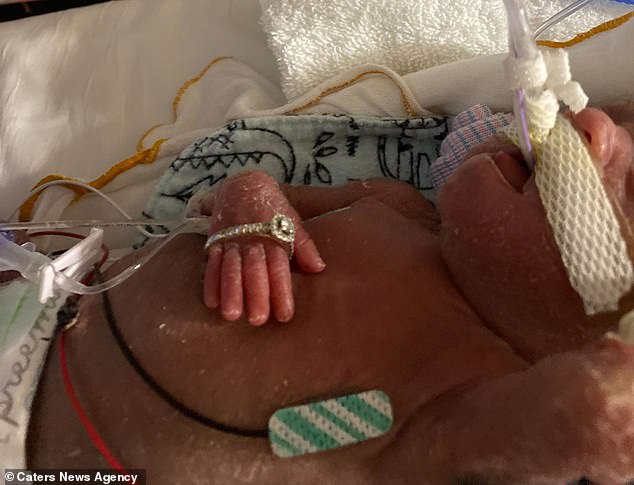 Das Baby verbrachte mehrere Monate im Krankenhaus und wurde rund um die Uhr überwacht.  Das Bild oben zeigt, dass seine Hand so klein war, dass ein ganzer Ring darüber passen konnte.