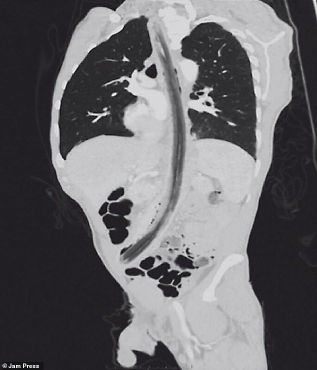 Ein 52-jähriger Mann in Guatemala kam ins Krankenhaus, nachdem ein 30 cm langer Stock in seiner Speiseröhre oder Speiseröhre steckengeblieben war (im Bild: Scans, die den Stock zeigen).