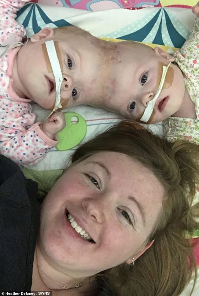 Abby und Erin Delaney wurden im Alter von 30 Wochen geboren, getrennt durch ihre Schädel.  Ihnen wurde nur eine Überlebenschance von zwei Prozent eingeräumt