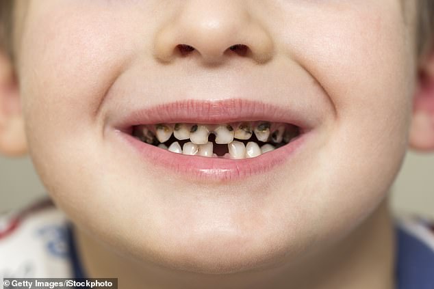 Säure ist eine der Hauptursachen für Zahnerosion – sie zersetzt und schwächt den harten Zahnschmelz, der Ihre Zähne bedeckt