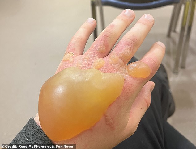 Ein Jugendlicher hatte nach einem kurzen Kontakt mit dem Riesenbärenklau eine Blase in der Größe einer Orange und hatte Mühe, sich wieder anzuziehen