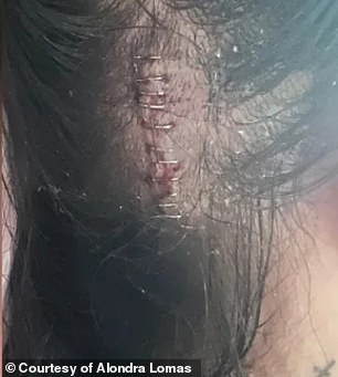 Alondras Klammern in ihrem Kopf von einer Operation, die sie im Krankenhaus hatte