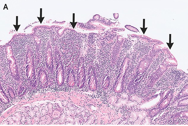 Das Obige zeigt einen Abschnitt des Darms des Mannes, wie er unter einem Mikroskop dargestellt wird.  Die Pfeile deuten auf eine Abstumpfung der Zotten hin – wenn fingerartige Vorsprünge, die bei der Nährstoffaufnahme helfen, reduziert werden.  Dies kann durch Probleme des Immunsystems verursacht werden