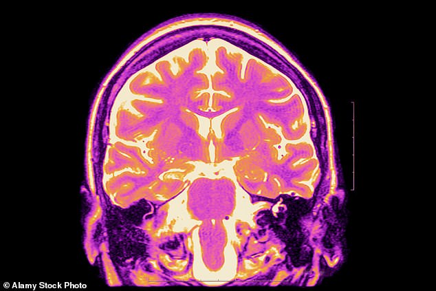 Jüngste Tierversuche deuten darauf hin, dass die Innovationen als potenzielle Heilung dienen könnten, sagen Wissenschaftler (Stockbild von MRIScan des von Epilepsie betroffenen Gehirns)