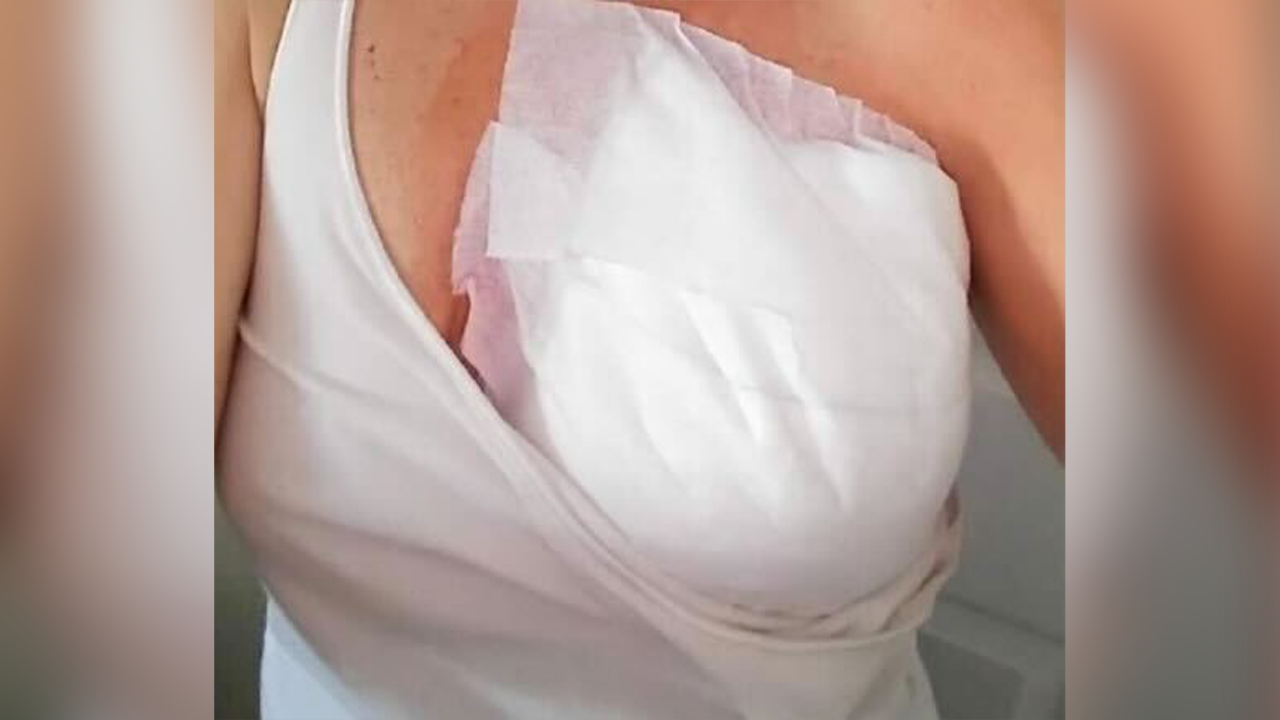 Tami Burdick Brust nach der Operation