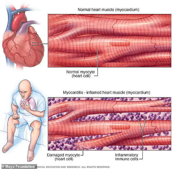 This illustration shows normal heart muscle compared to inflamed heart muscle due