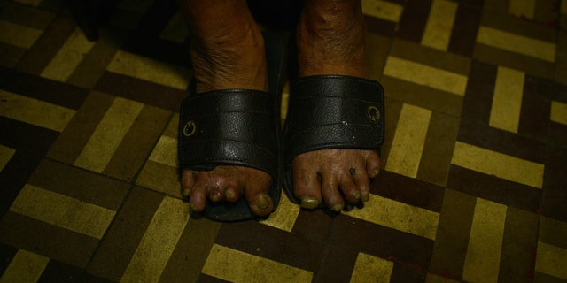 A Brazil man's feet show impacts of leprosy 