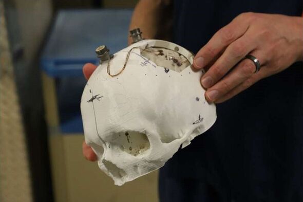 A 3D-printed model of Mr Thomas' skull