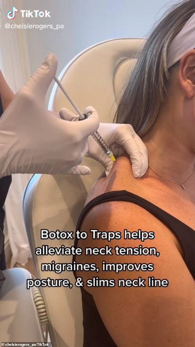Another beauty trend known as 'traptox' involves women getting Botox injections in their trapezius muscles
