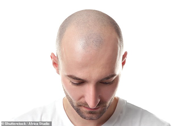 Haarausfall bei Männern tritt auf, wenn übermäßige Mengen des Sexualhormons Dihydrotestosteron produziert werden, das den Wachstumszyklus der Haare stört