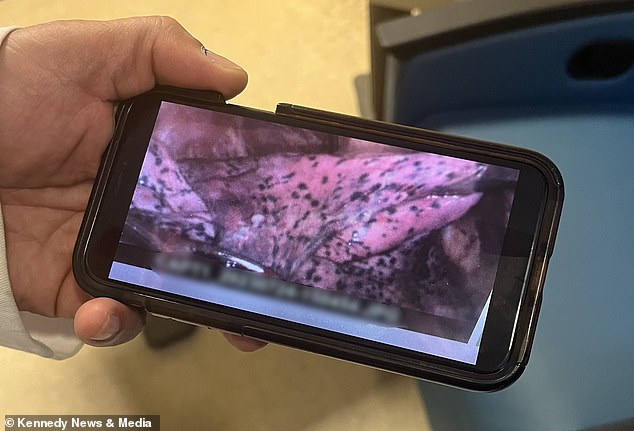 Beunruhigende Fotos, die vor der Operation mit einem Endoskop aufgenommen wurden, zeigen, dass die Oberfläche von Seans Lunge mit schwarzen Flecken bedeckt ist. Er behauptet, es handele sich um Kohlenstoffablagerungen, die durch starkes Dampfen in den letzten fünf Jahren entstanden seien