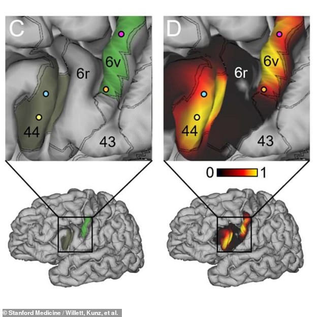 Mit der Connectome Workbench-Software erstellte Karten zeigen die Stellen im Gehirn der Patientin Pat Bennett, an denen eine Reihe von Siliziumelektroden in ihre Großhirnrinde implantiert wurden