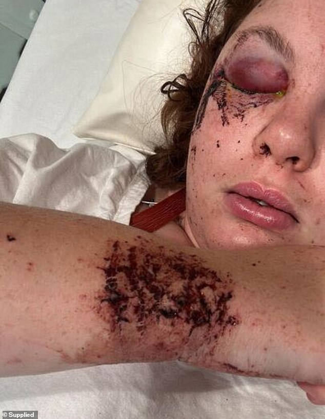 Tori (im Bild nach dem Unfall) verbrachte vier Tage im Westmead Hospital mit mehreren Brüchen, einer Gehirnerschütterung und einer Handgelenksverletzung
