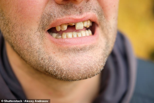 Laut der Epilepsy Society hat die Hälfte derjenigen, die durch einen epileptischen Anfall Zahnverletzungen erlitten haben, wie z. B. abgebrochene oder abgebrochene Zähne, diese wegen der hohen Behandlungskosten nicht reparieren lassen