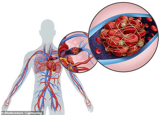 Blood clots in the lungs, known as a pulmonary embolism, lead to about 25,000 deaths in the UK every year (Pictured, an illustration of a blood clot in the lungs)