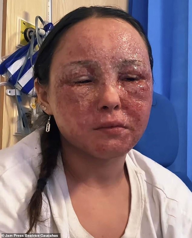 Das Ekzem von Beatrice Gaucahas (im Bild während ihres Krankenhausaufenthalts), das zu Rötungen und Blasenbildung auf der Haut führt, verschlimmerte sich, als es sich auf ihr Gesicht ausbreitete und sie ins Krankenhaus brachte