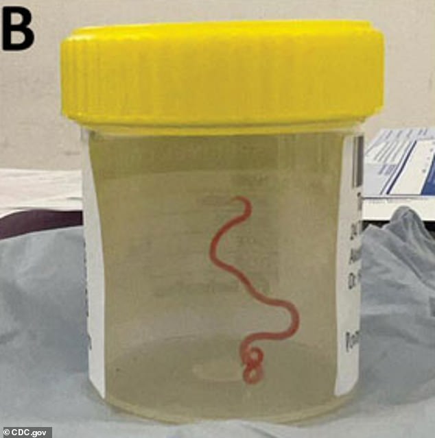 Die Mediziner waren schockiert, als sie einen 8 cm großen lebenden und sich windenden parasitären Wurm aus dem Gehirn der 64-jährigen Frau zogen
