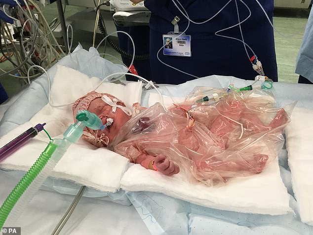 The girl was saved by doctors after she was born with her heart outside her chest