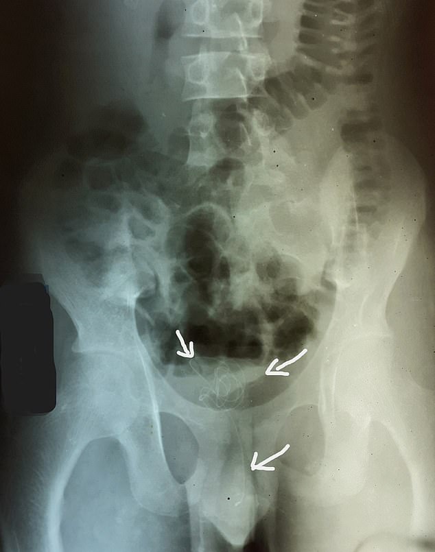 Eine Röntgenaufnahme des Beckens des Mannes zeigte einen undurchsichtigen Fremdkörper in der Beckenhöhle (auf dem Scan erkennbar), der sich bis in die mittlere Harnröhre erstreckte