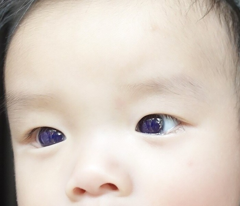 Nach Absetzen des Medikaments kehrte die natürliche Augenfarbe des Kindes schnell zurück und schien keine Schäden davongetragen zu haben. 