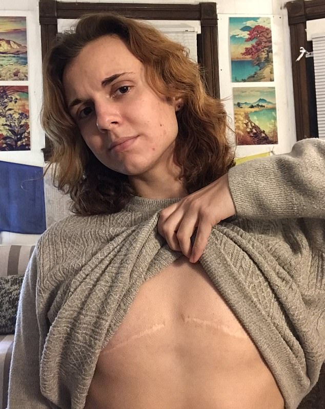 Luka zeigt die Narben auf ihrer Brust nach ihrer irreversiblen Doppelmastektomie